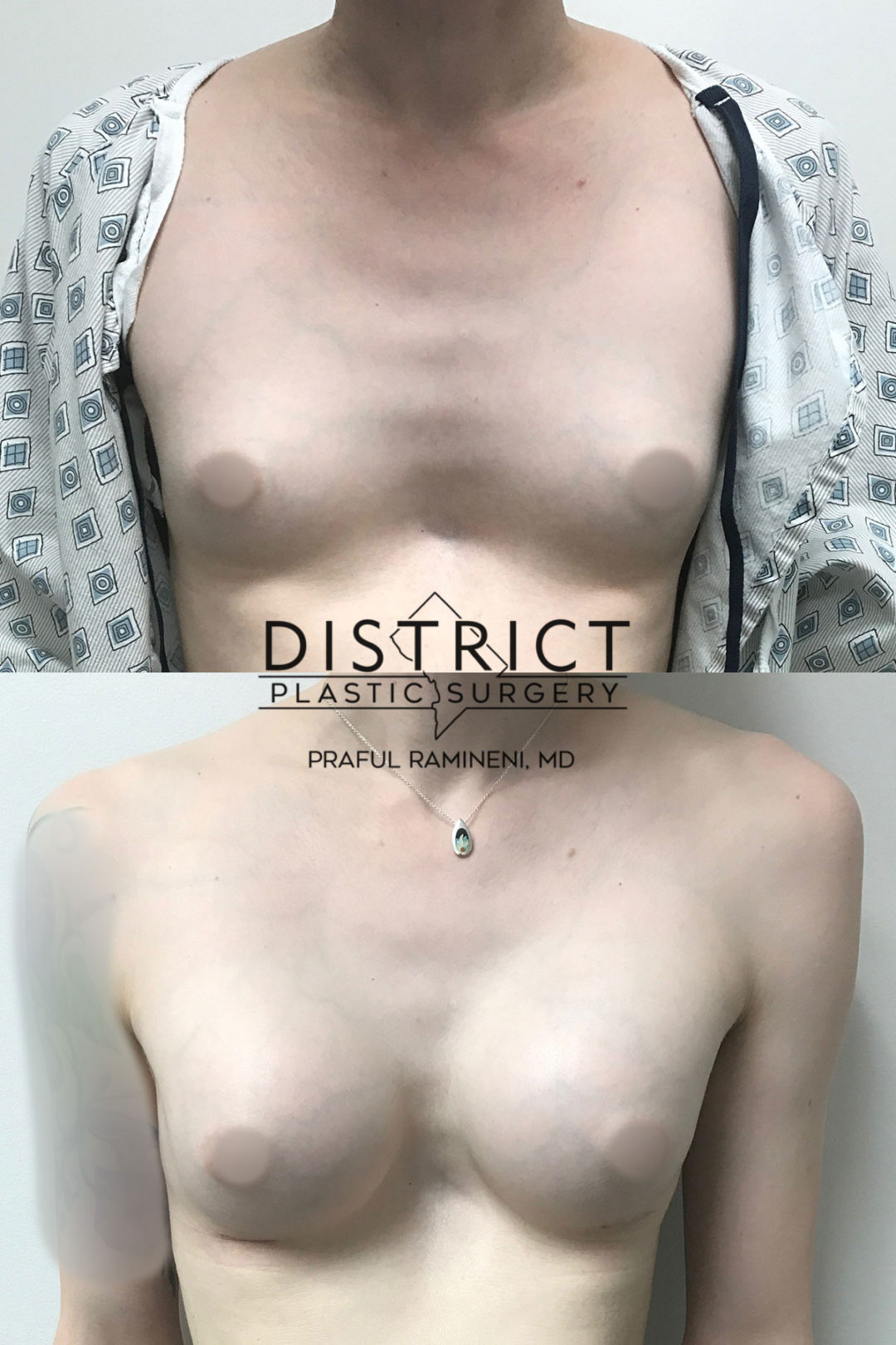 male to female gender-affirming surgery before and after