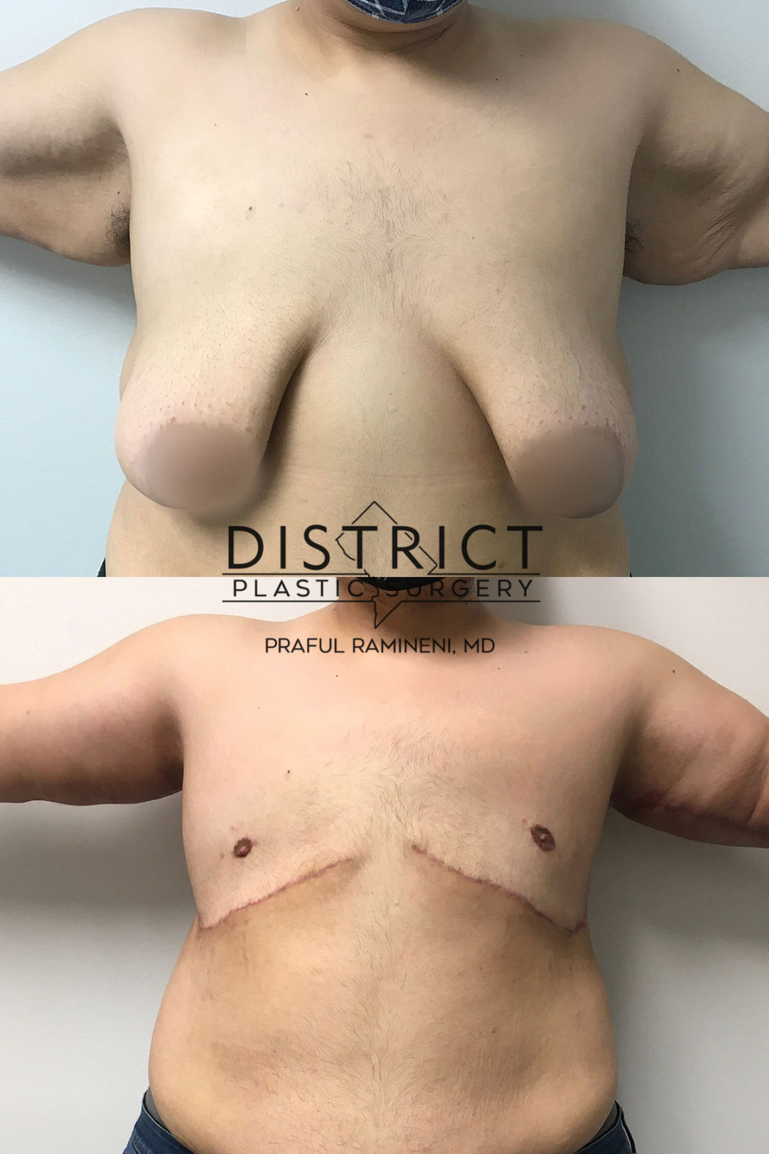 double incision mastectomy before and after ohoto