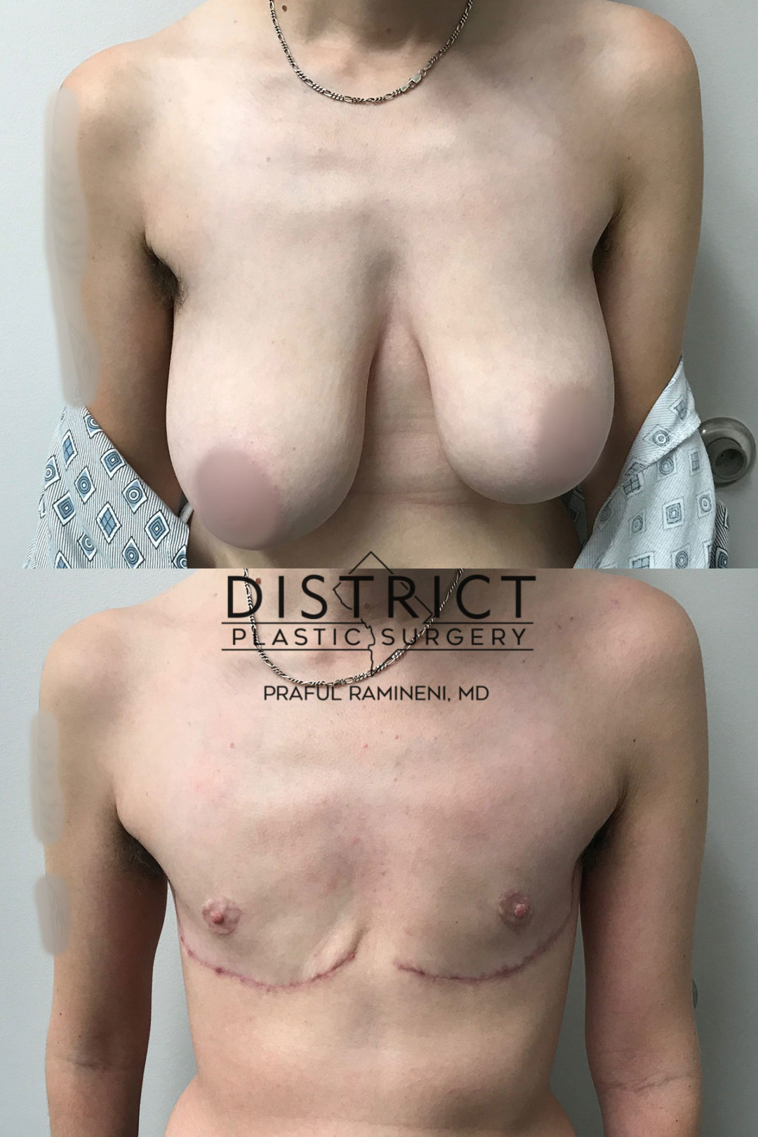 double incision mastectomy before and after