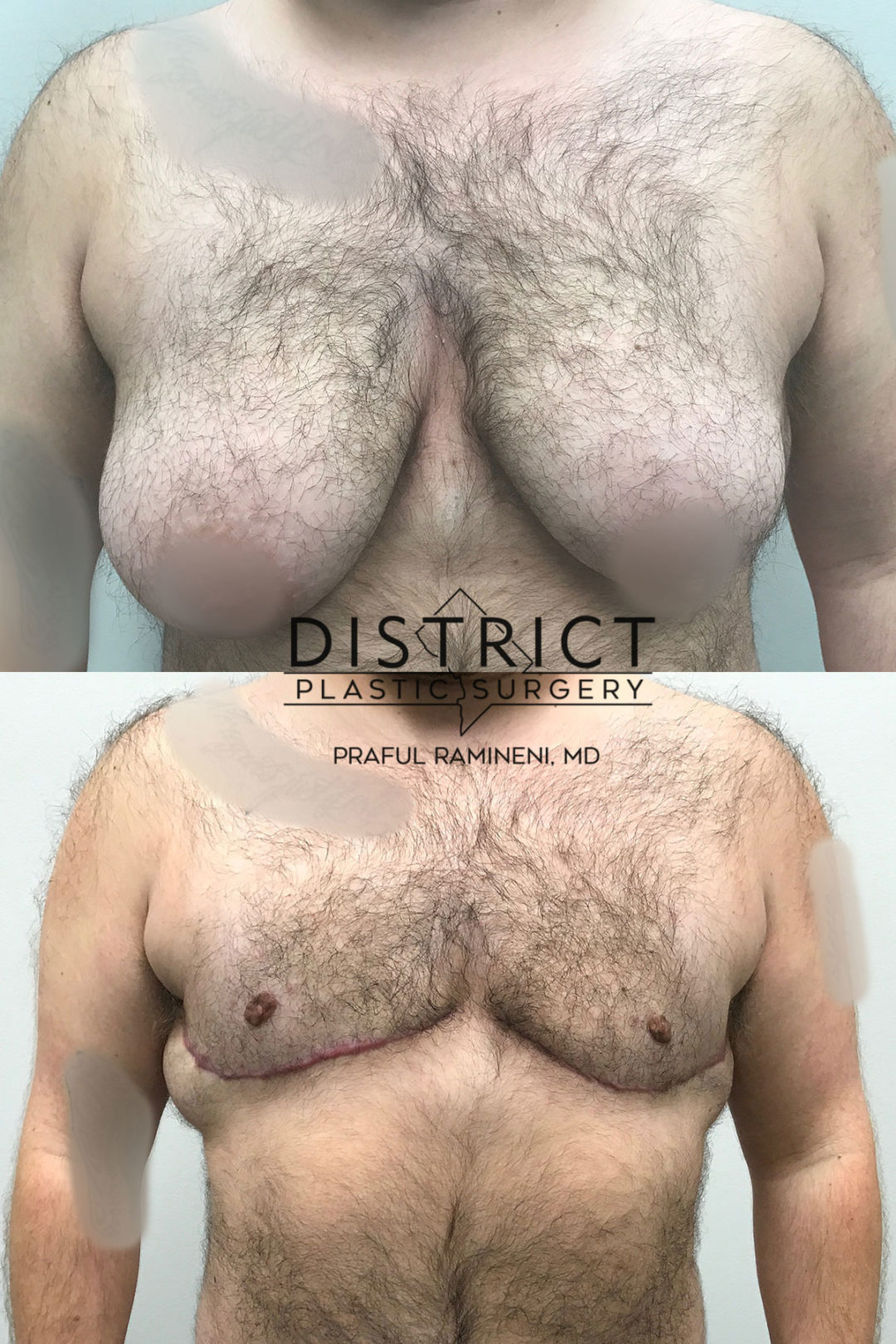 double incision mastectomy before and after
