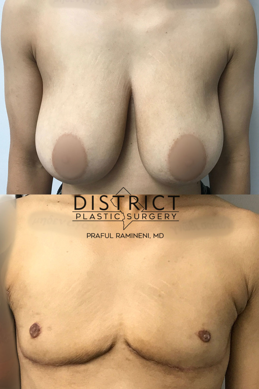 double incision mastectomy before and after
