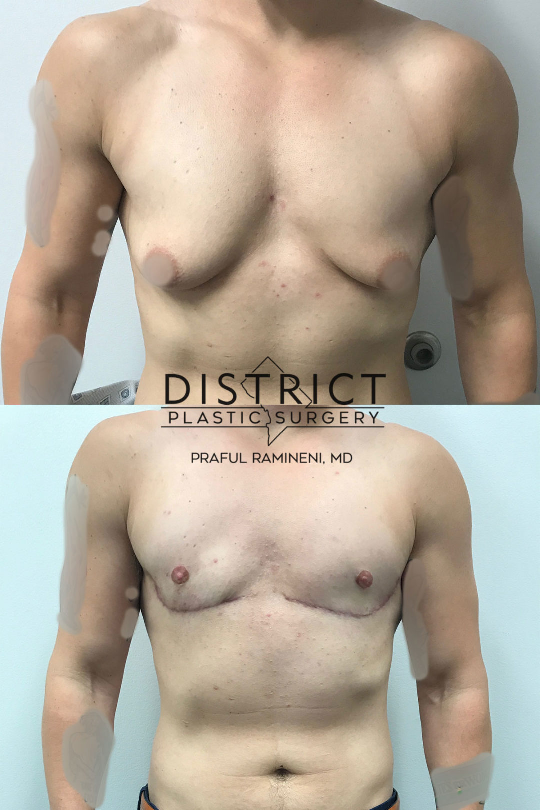 double incision mastectomy before and after