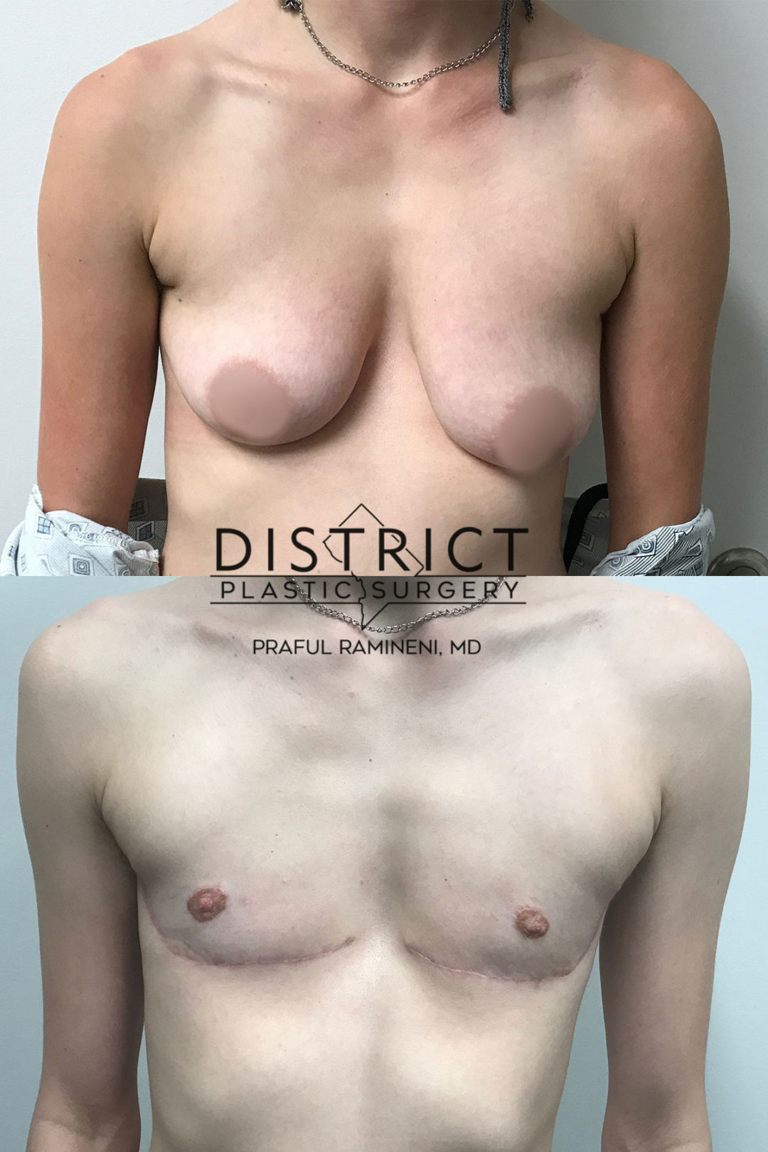double incision mastectomy before and after