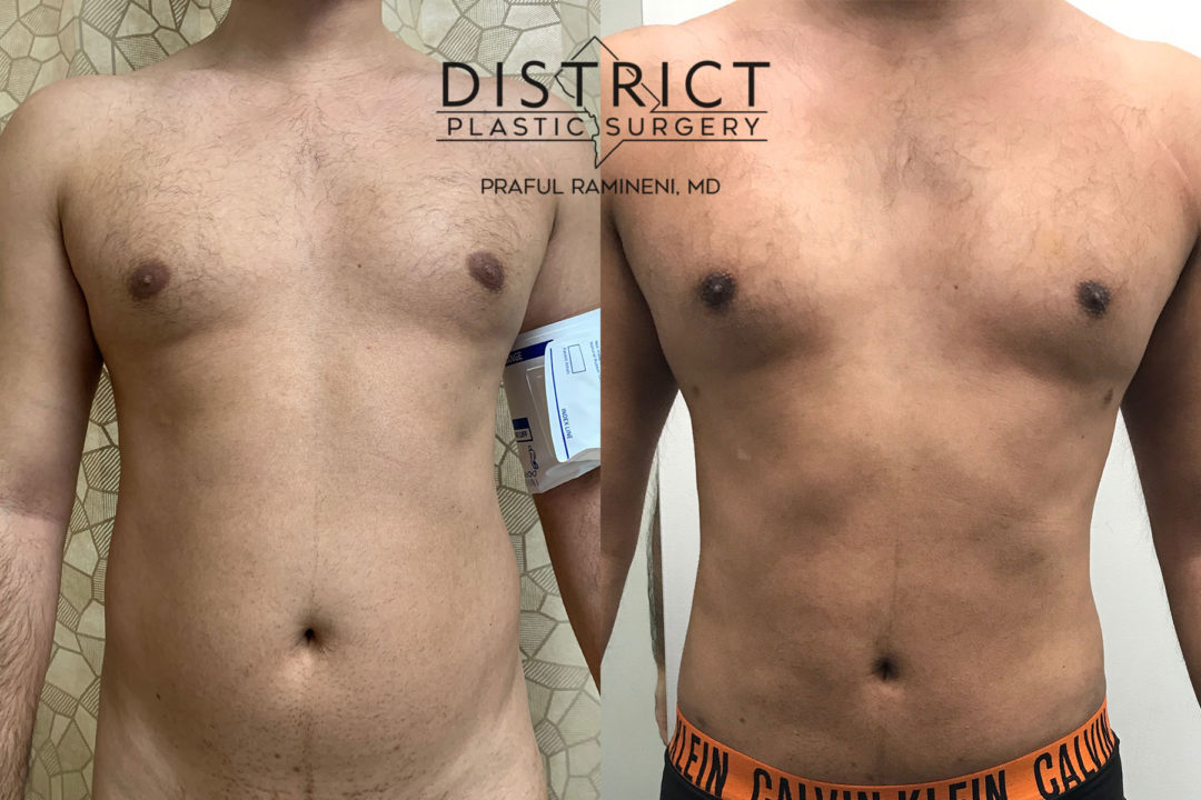 liposuction before and after