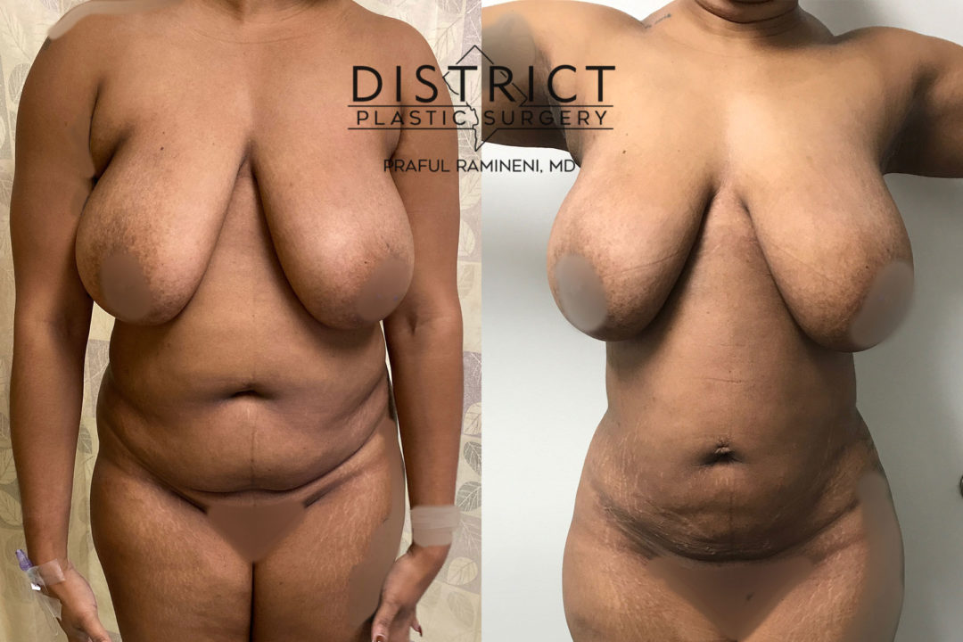 liposuction before and after