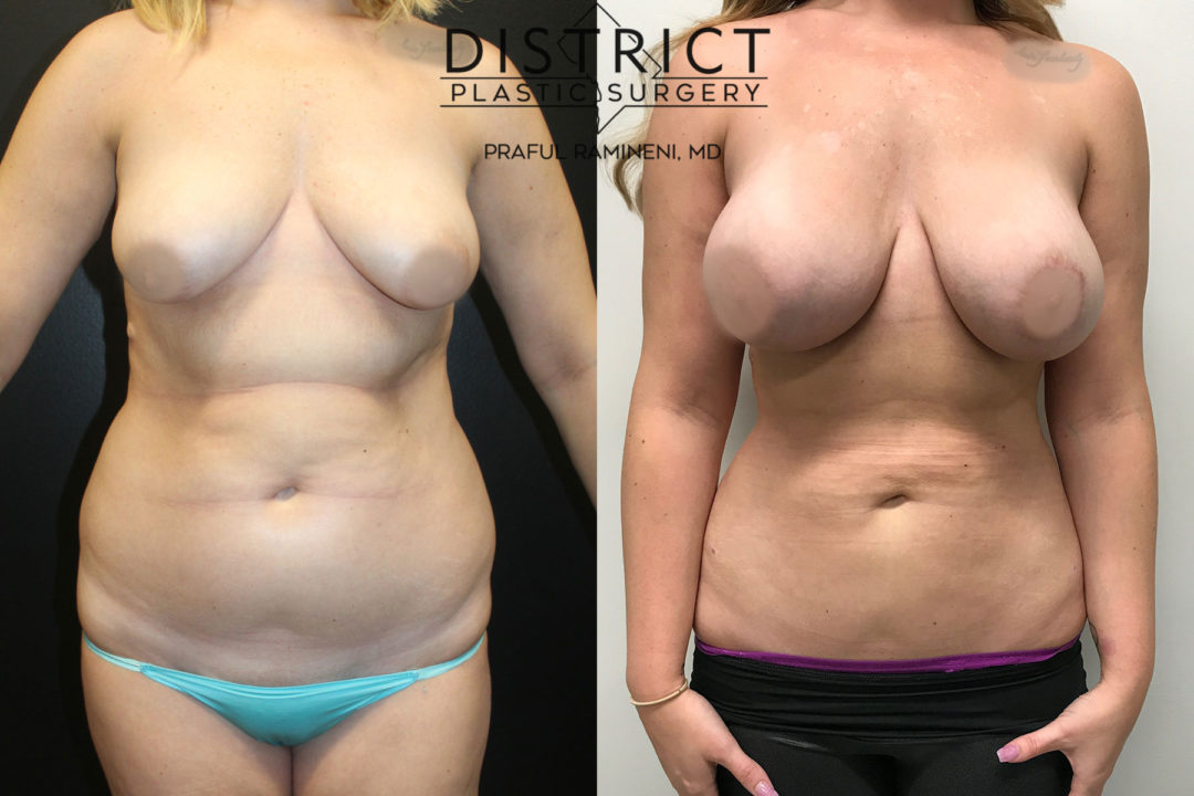liposuction before and after