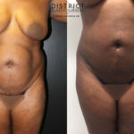 liposuction before and after
