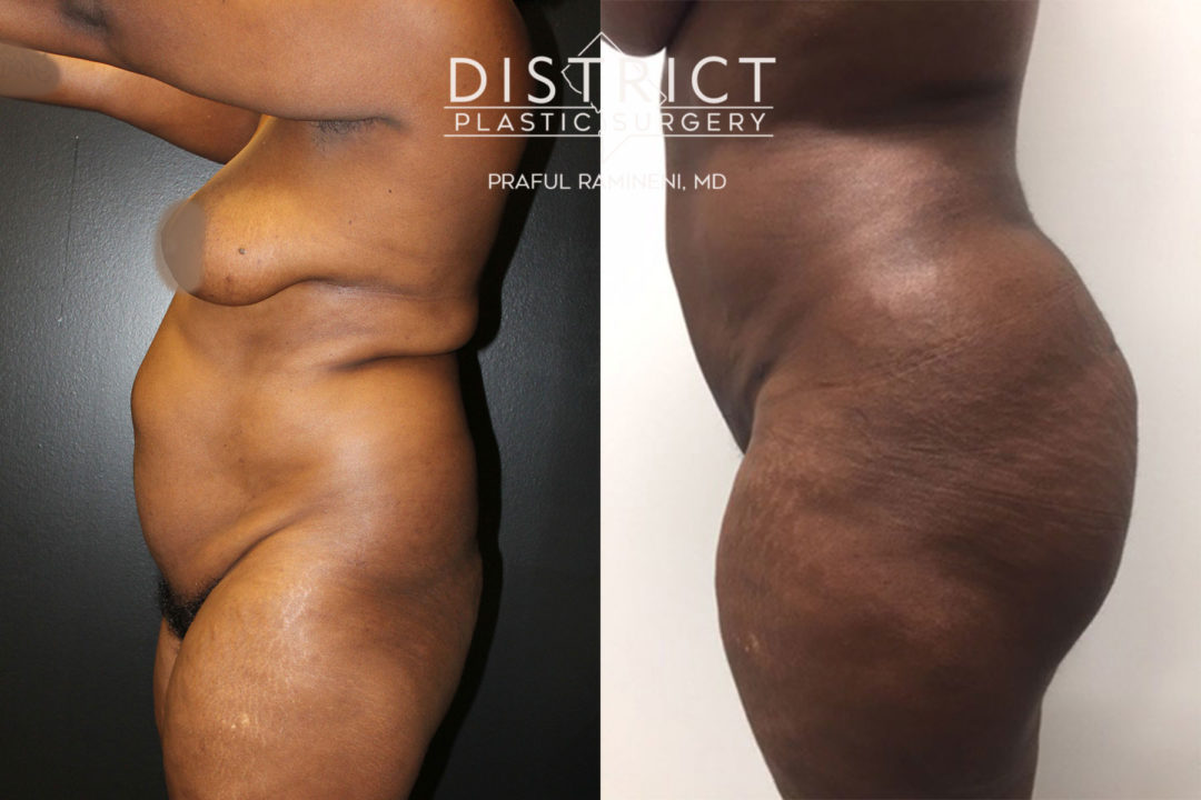 liposuction before and after
