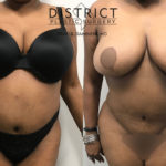liposuction before and after