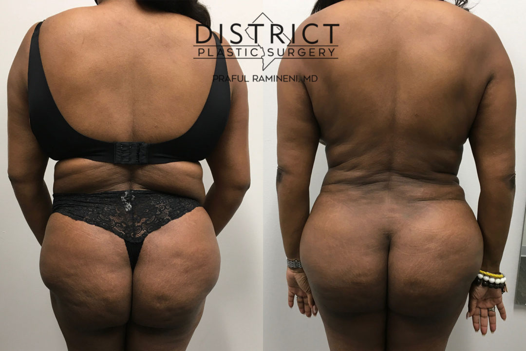 liposuction before and after