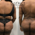 liposuction before and after