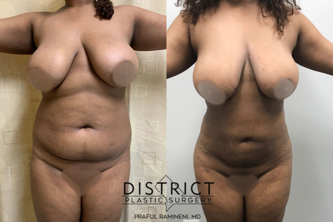 liposuction before and after