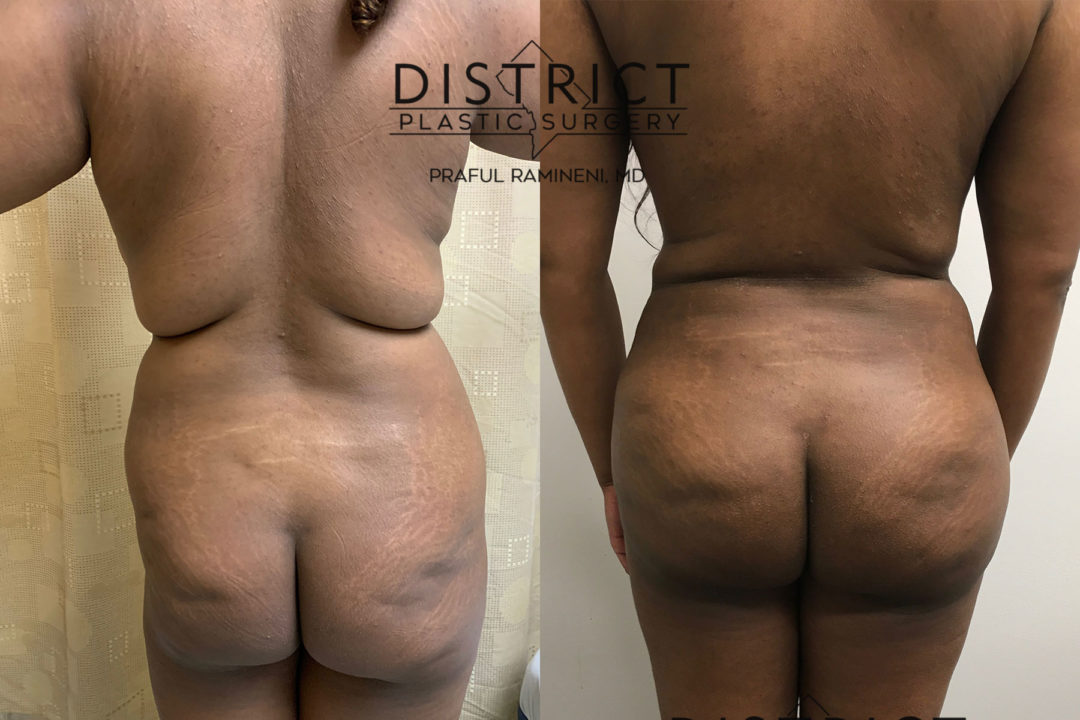 liposuction before and after