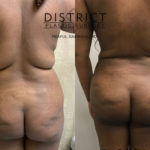 liposuction before and after
