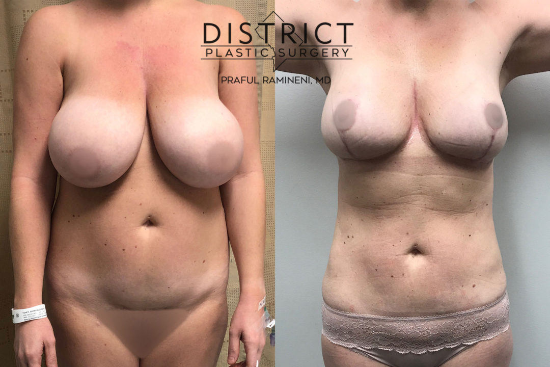 liposuction before and after