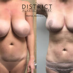 liposuction before and after