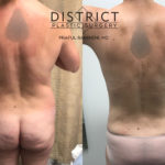 liposuction before and after