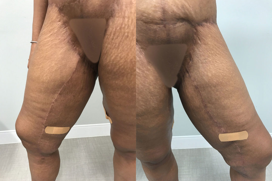 thigh lift before and after