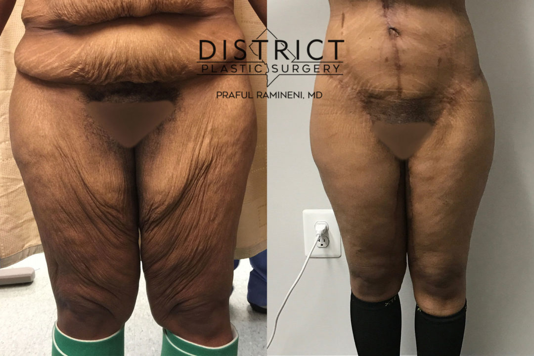 thigh lift before and after