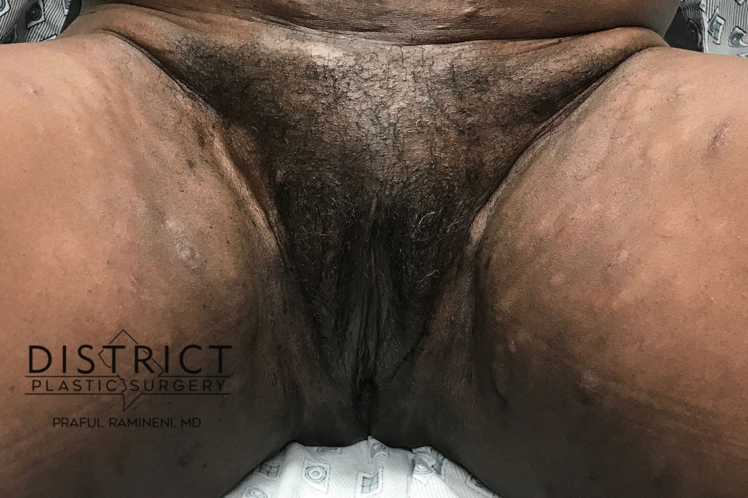 vaginoplasty before and after