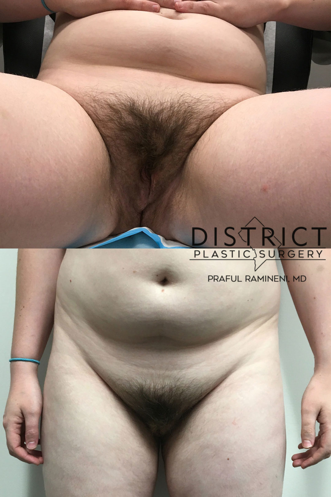 vaginoplasty before and after