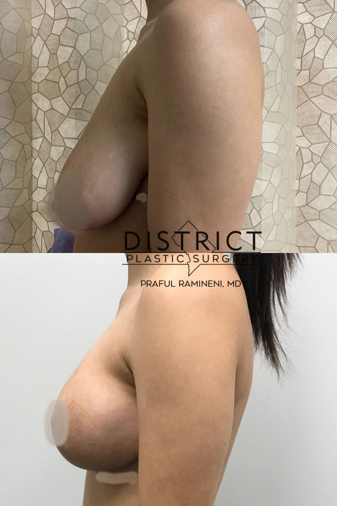 breast augmentation before and after