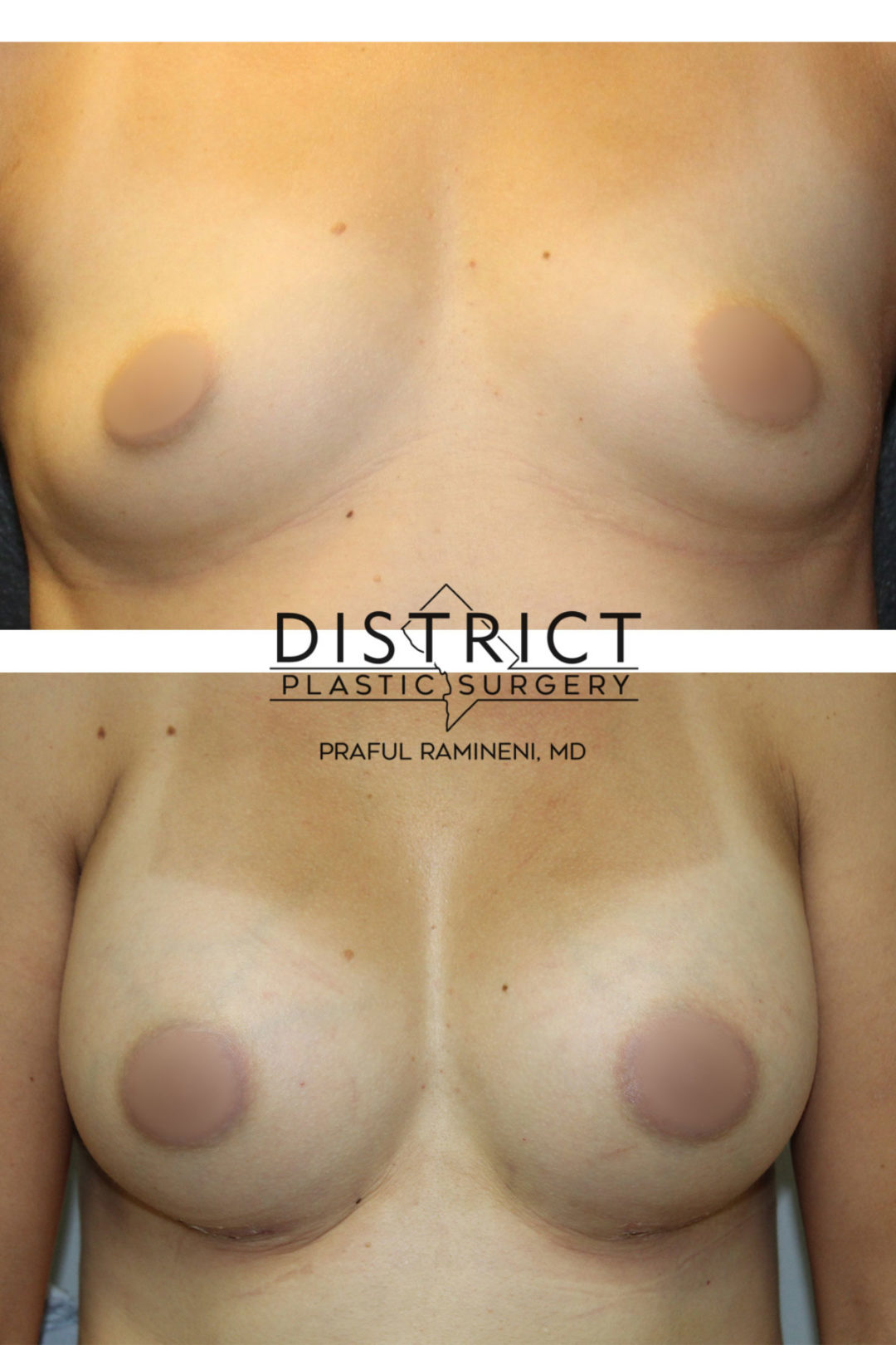 breast augmentation before and after