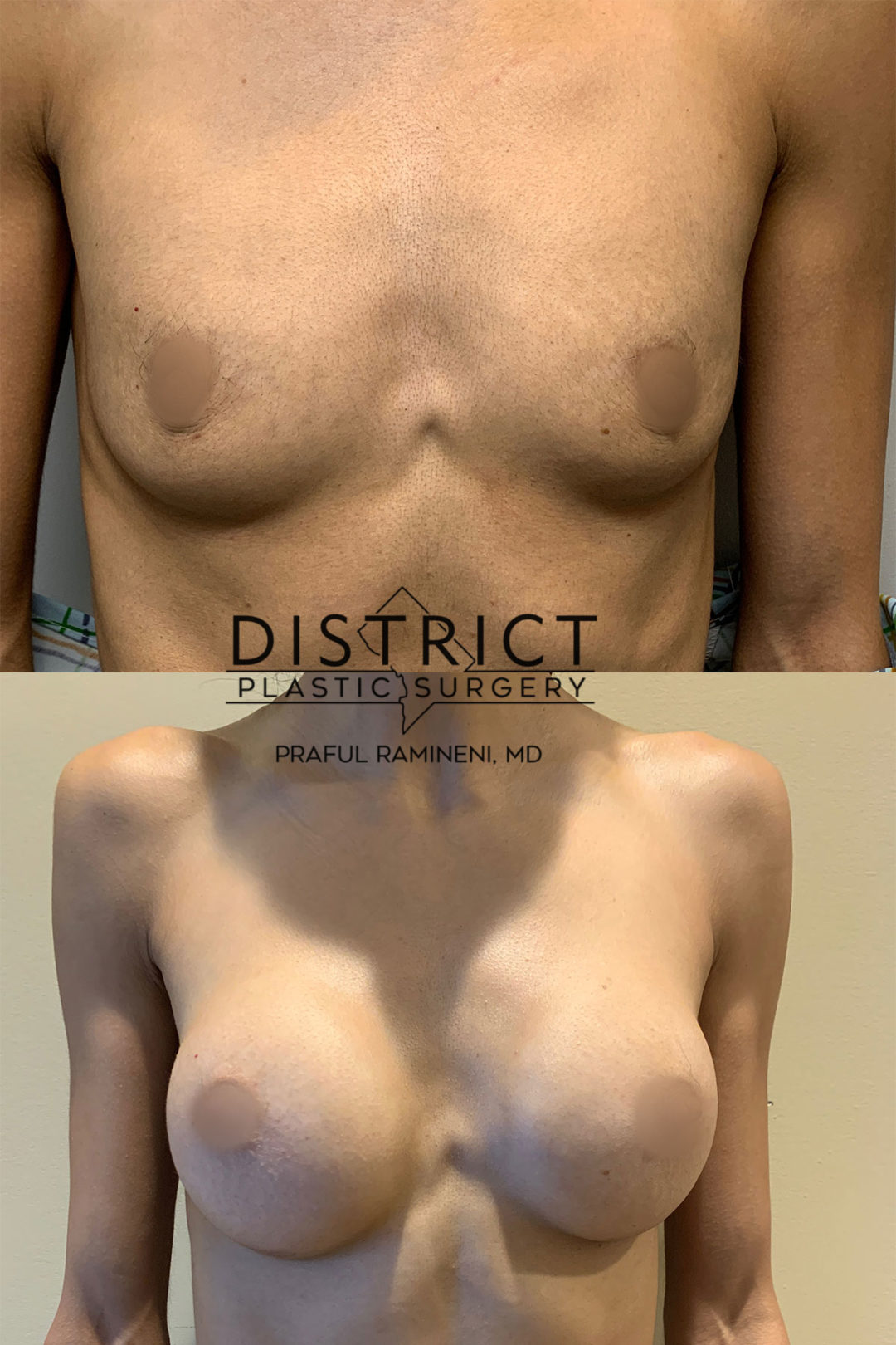 breast augmentation before and after