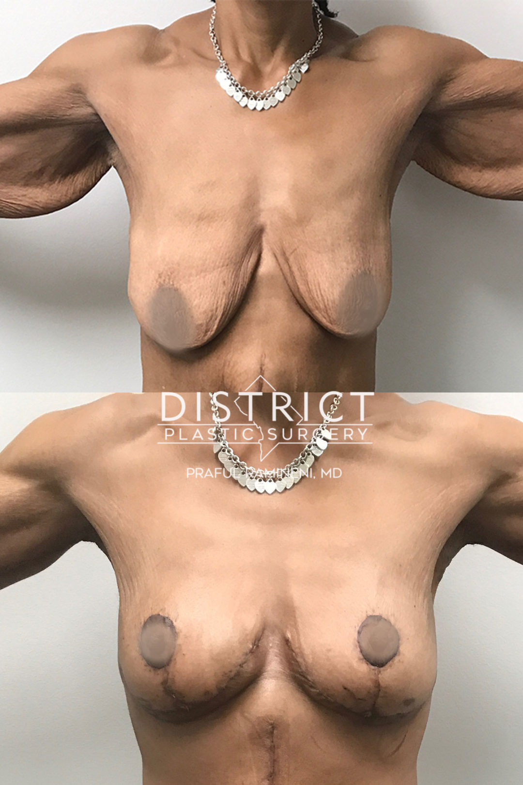 breast augmentation before and after
