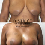 breast lift before and after