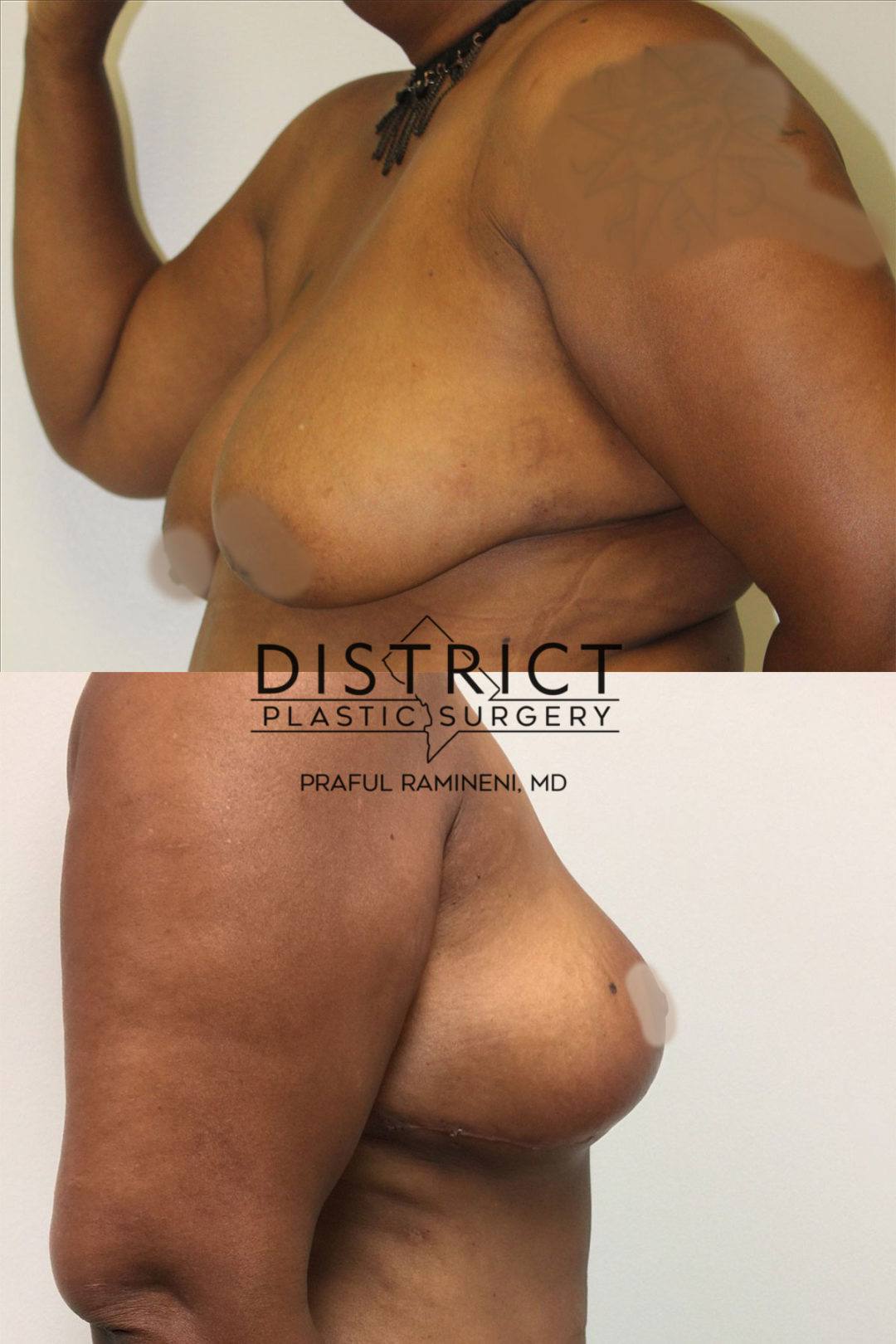 breast lift before and after