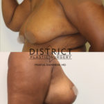 breast lift before and after