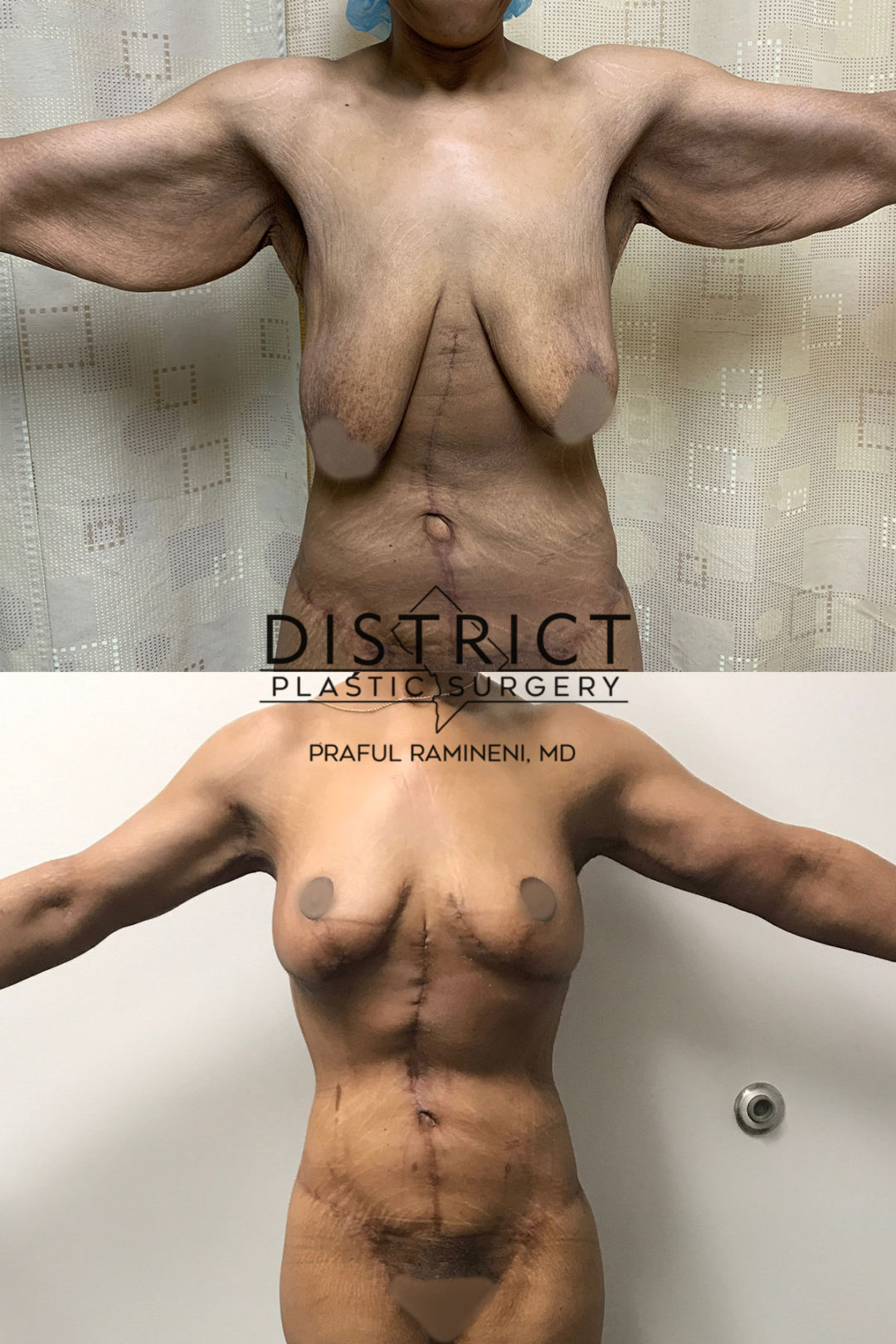 breast lift before and after