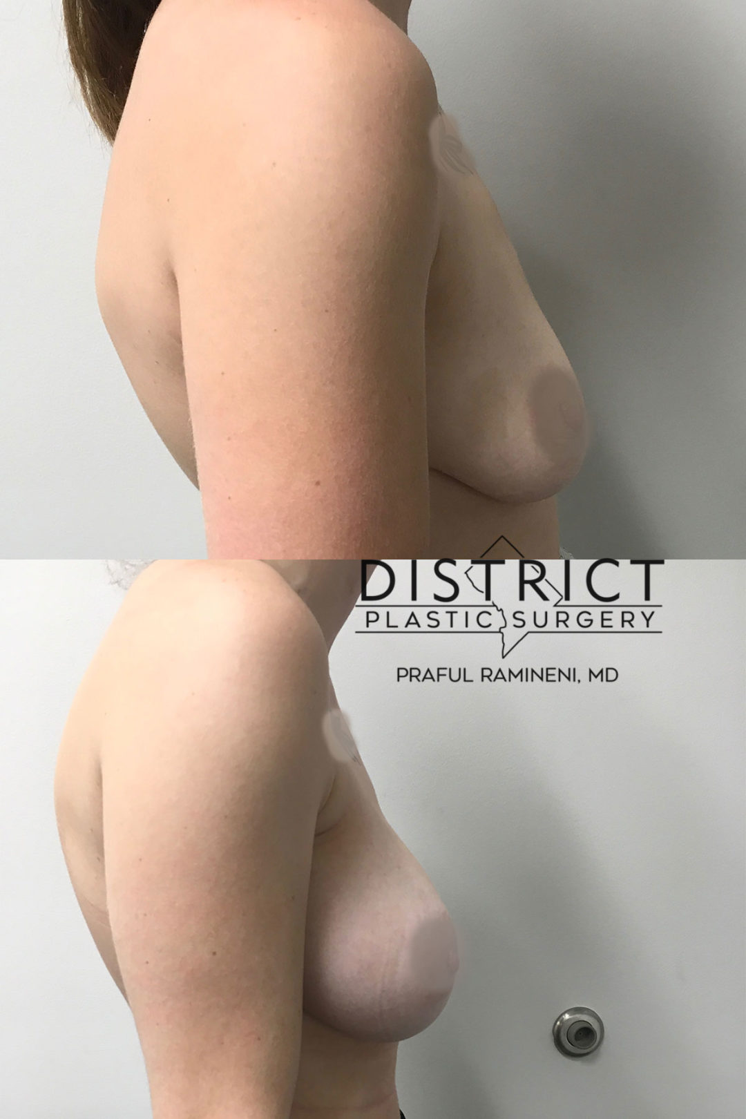 breast lift before and after
