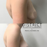 breast lift before and after