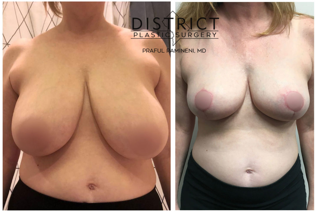 breast reduction before and after