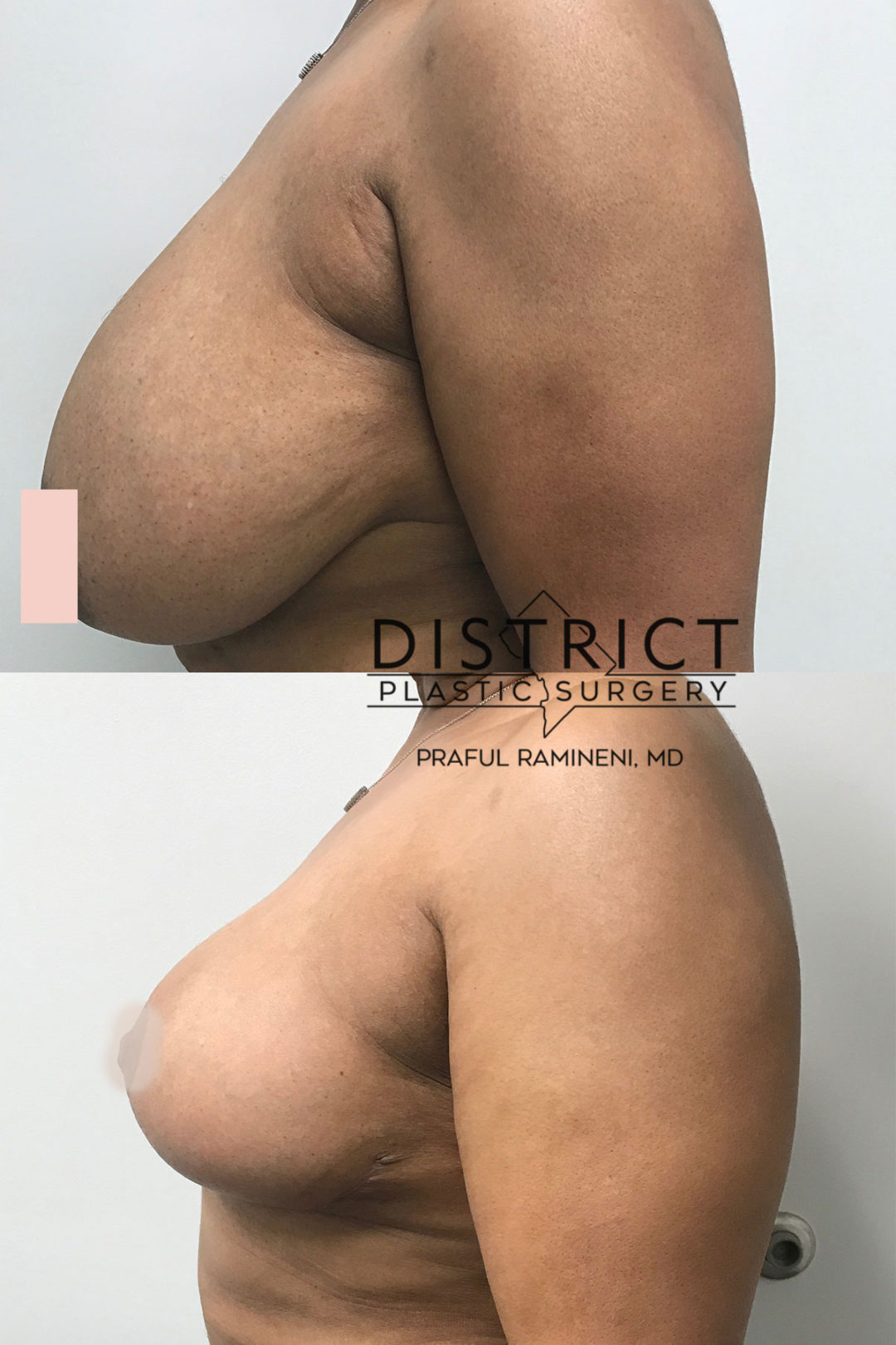 breast reduction before and after