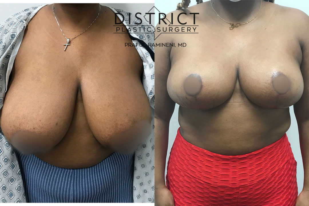 breast reduction before and after