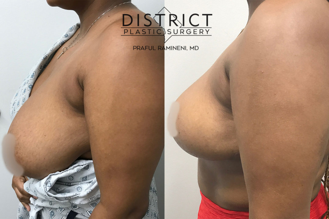breast reduction before and after
