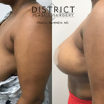 breast reduction before and after