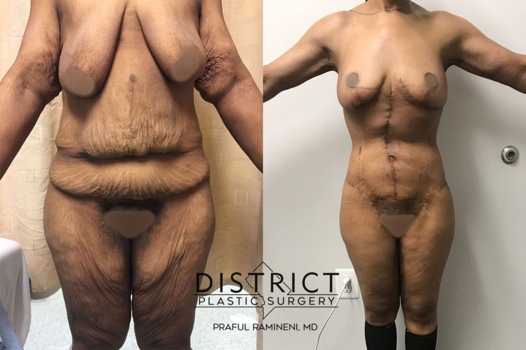 massive weightloss surgery before and after