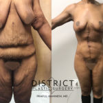 massive weightloss surgery before and after