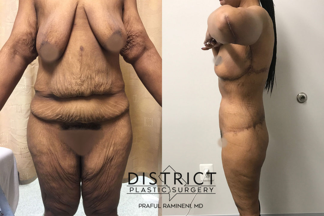 massive weightloss surgery before and after
