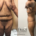 massive weightloss surgery before and after