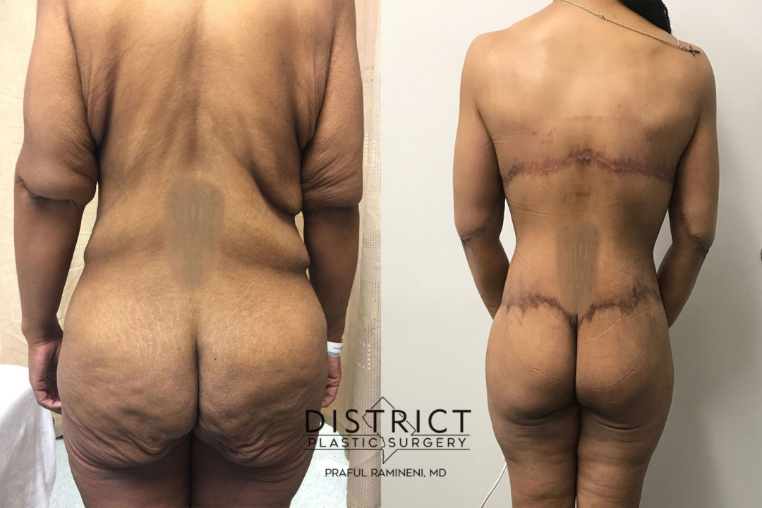 massive weightloss surgery before and after