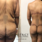 massive weightloss surgery before and after