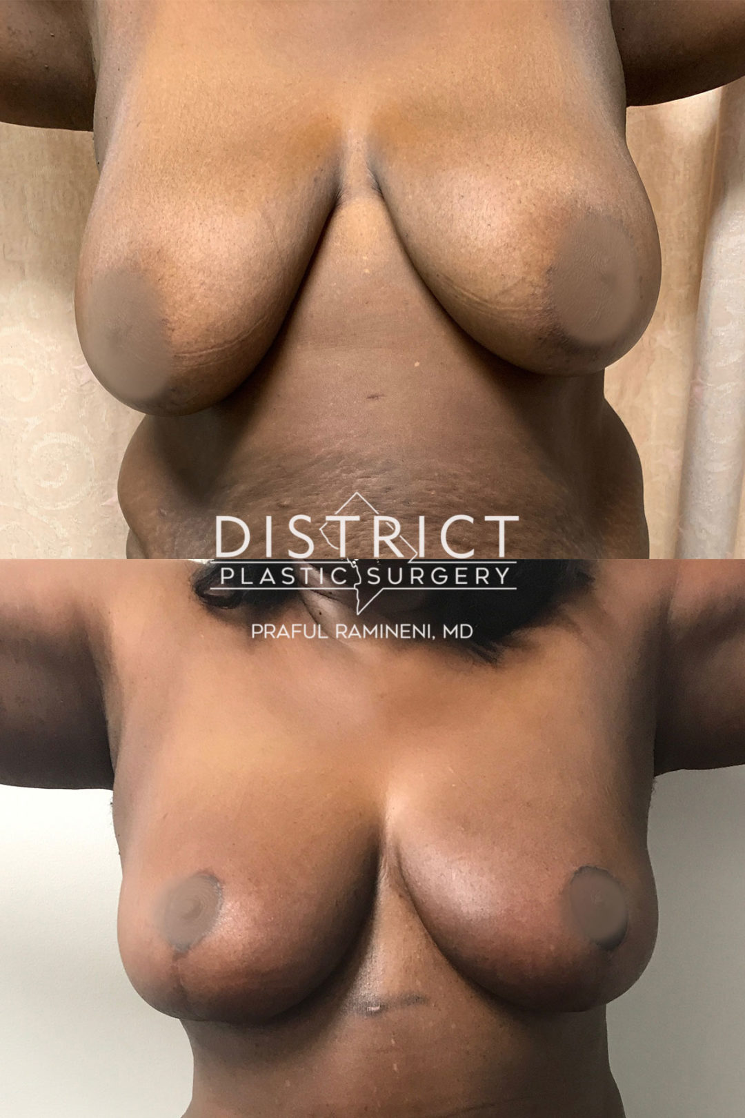 breast reduction before and after