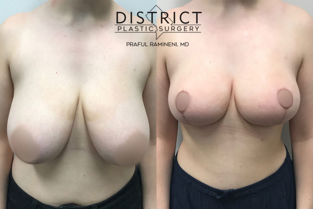 breast reduction before and after