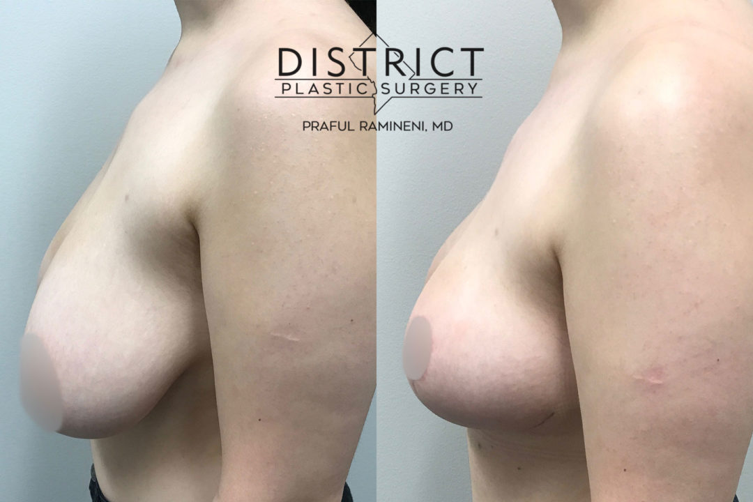 breast reduction before and after