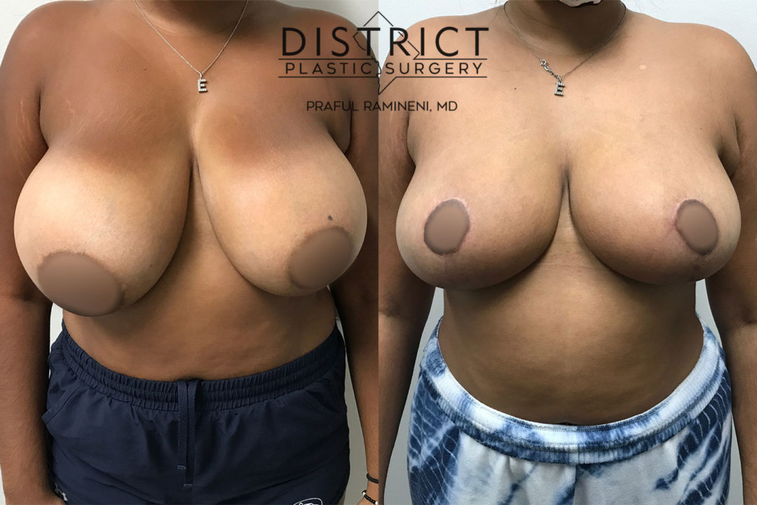 breast reduction before and after